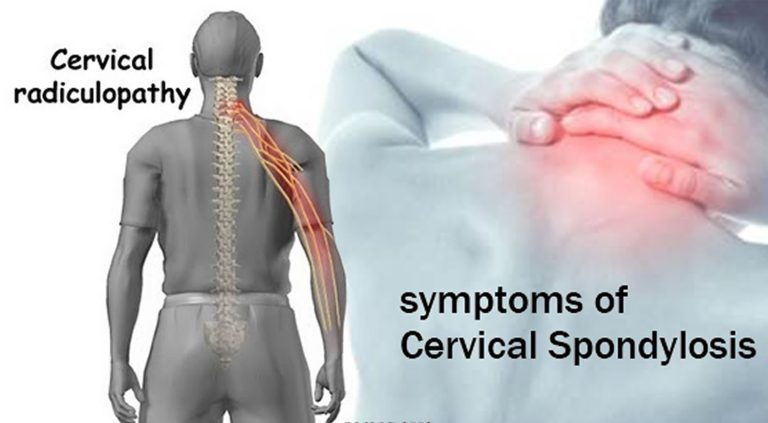 Cervical-Spondylosis