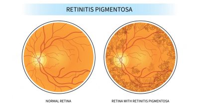 Recent Developments in Gene Therapy for X-linked Retinitis Pigmentosa