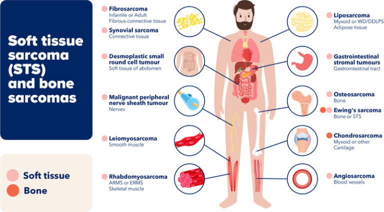 soft tissue sacromas and bone sarcoma
