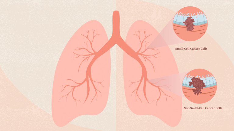 types-of-lung-cancer-alt-1440x810